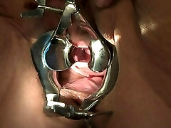 thicker Speculum in Peehole of Sub B Part II
