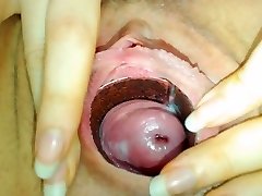 bashful cervix